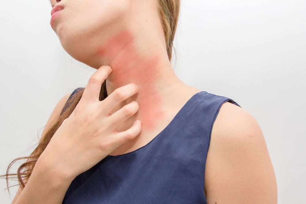 Sun Allergy - All You need To Know Abou It | The Dermo Lab