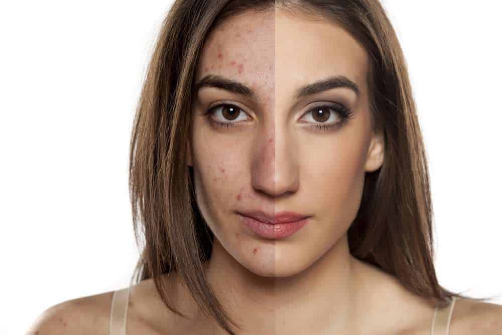 5-simple-daily-habits-to-get-rid-of-blind-pimples