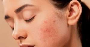 what causes acne?