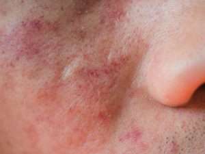eczema on face
