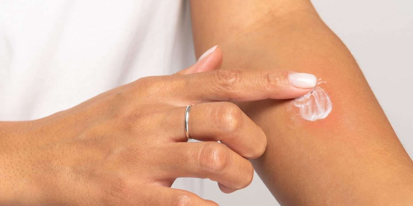 The Best Eczema Cream for Soothing Dry, Itchy Skin