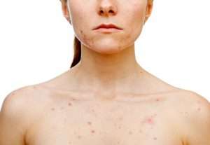 moderate acne