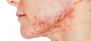 acne vulgaris