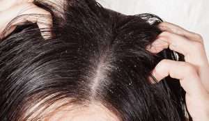 تعرف على انواع قشرة الشعر وطرق علاجها