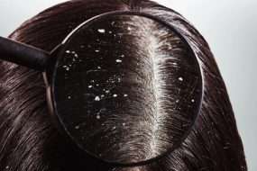 What is dandruff and how to get rid of it?