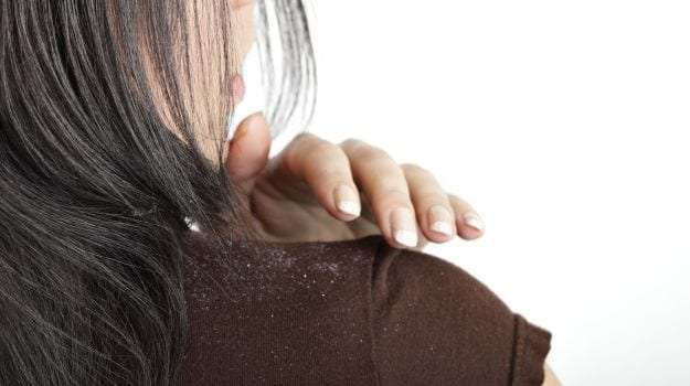 Dandruff Treatment