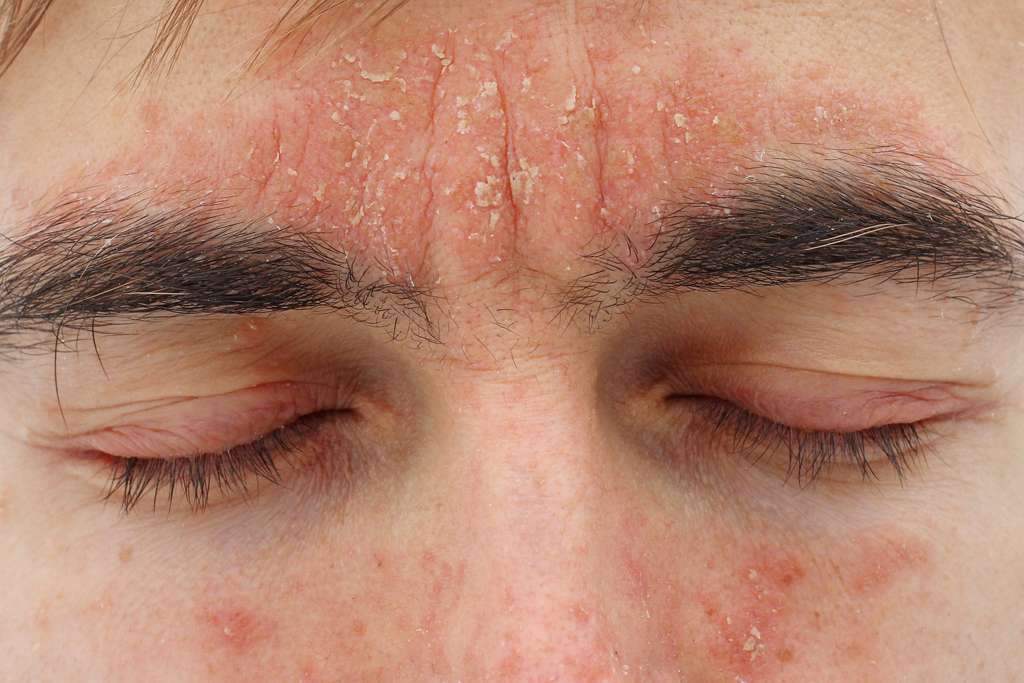 Seborrheic Dermatitis