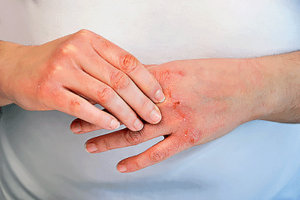 Eczema on hands