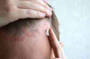 دليلك الشامل عن علاج التهاب الجلد الدهني