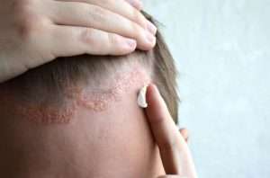 Seborrheic dermatitis treatment and management