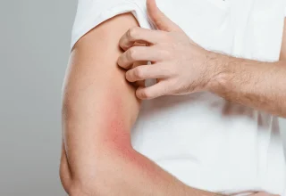What an eczema rash looks like