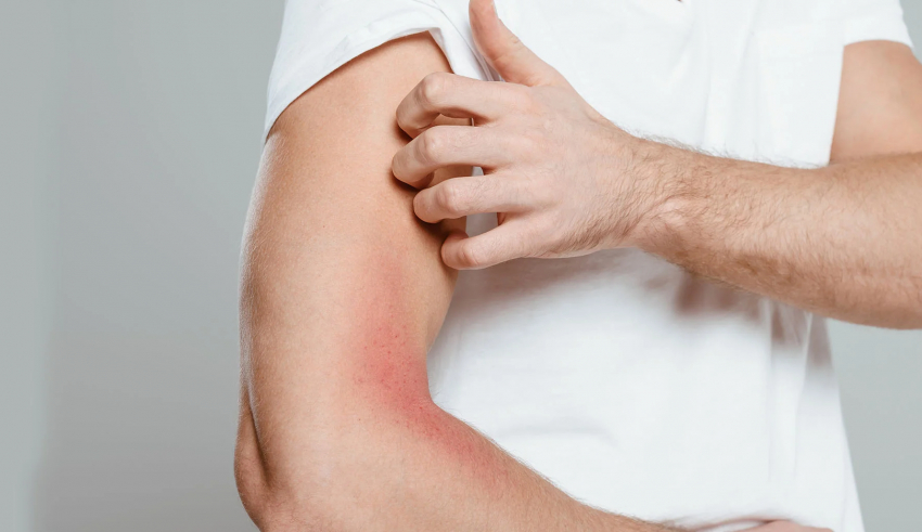 What an eczema rash looks like