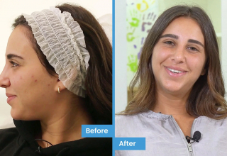 Dima Chahine's acne story