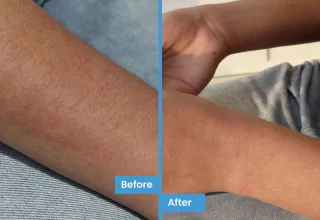 Nour's experience with eczema