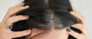 كيف تتخلص من التهاب الجلد الدهني على فروة الرأس؟