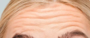 Forehead wrinkles: How to get rid of them 