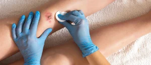 What are the different types of wounds? 