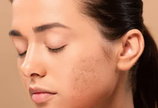 Acne scar treatment and removal techniques