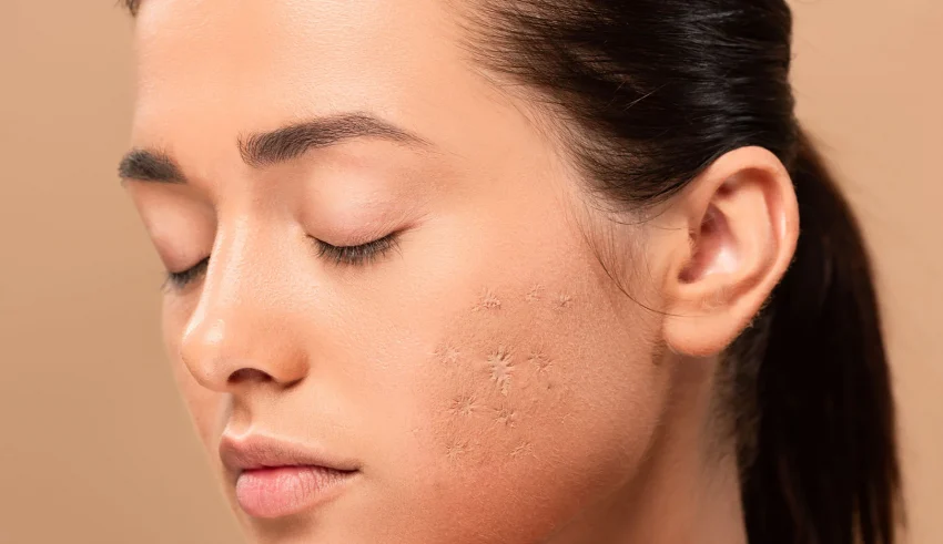 Acne scar treatment and removal techniques