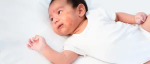 Here's what parents need to know about baby eczema