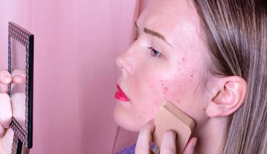 Covering Up, Not Covering Over: Makeup Hacks for Acne Sufferers